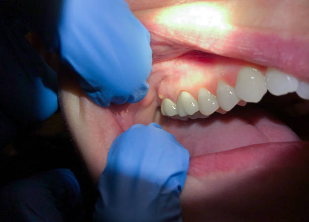 Best Emergency Care for Gum Disease in New Haven, MI