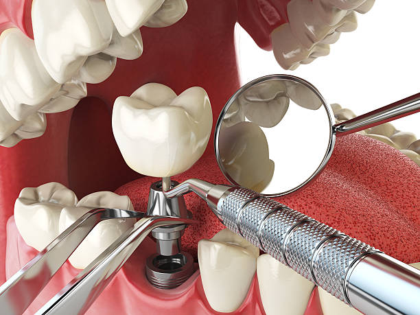 Best Emergency Wisdom Tooth Extraction in New Haven, MI